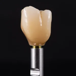 Coroa de zirconia sobre implante (1)