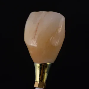 Coroa de zirconia sobre implante (3)