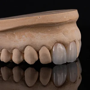 Coroa zirconia sobre dente (1)