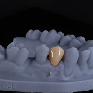 Coroa zirconia sobre dente (3)