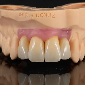 Coroa zirconia sobre dente (4)
