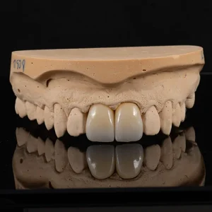 Coroa zirconia sobre dente (6)