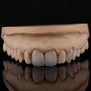 Coroa zirconia sobre dente (7)