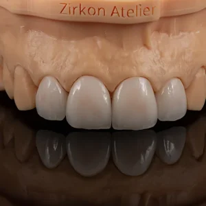 Facetas ceramicas