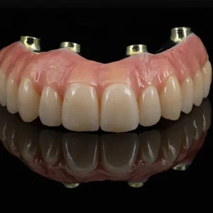 Ponte Total Zirconia sobre implantes (4)
