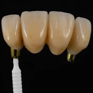 Ponte Zirconia sobre implantes (1)