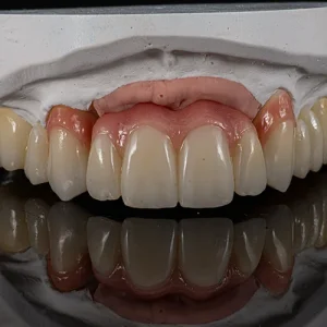 Pontes zirconia sobre dentes e implantes (1)