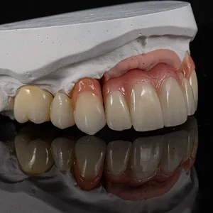Pontes zirconia sobre dentes e implantes (2)