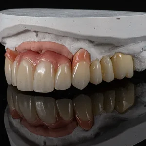 Pontes zirconia sobre dentes e implantes (3)