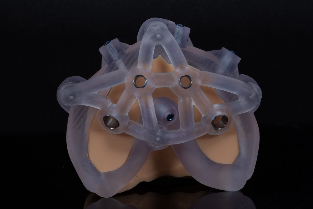Guia posicionamento de implantes (1)